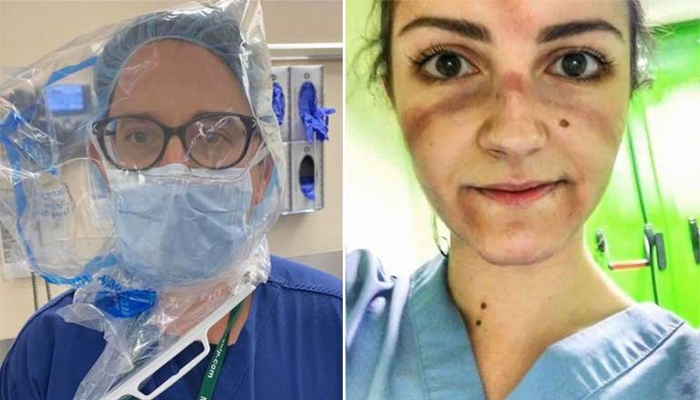 Acının izi yüzlerinde! Corona Virüs doktorları fotoğraflarını paylaşıyor!